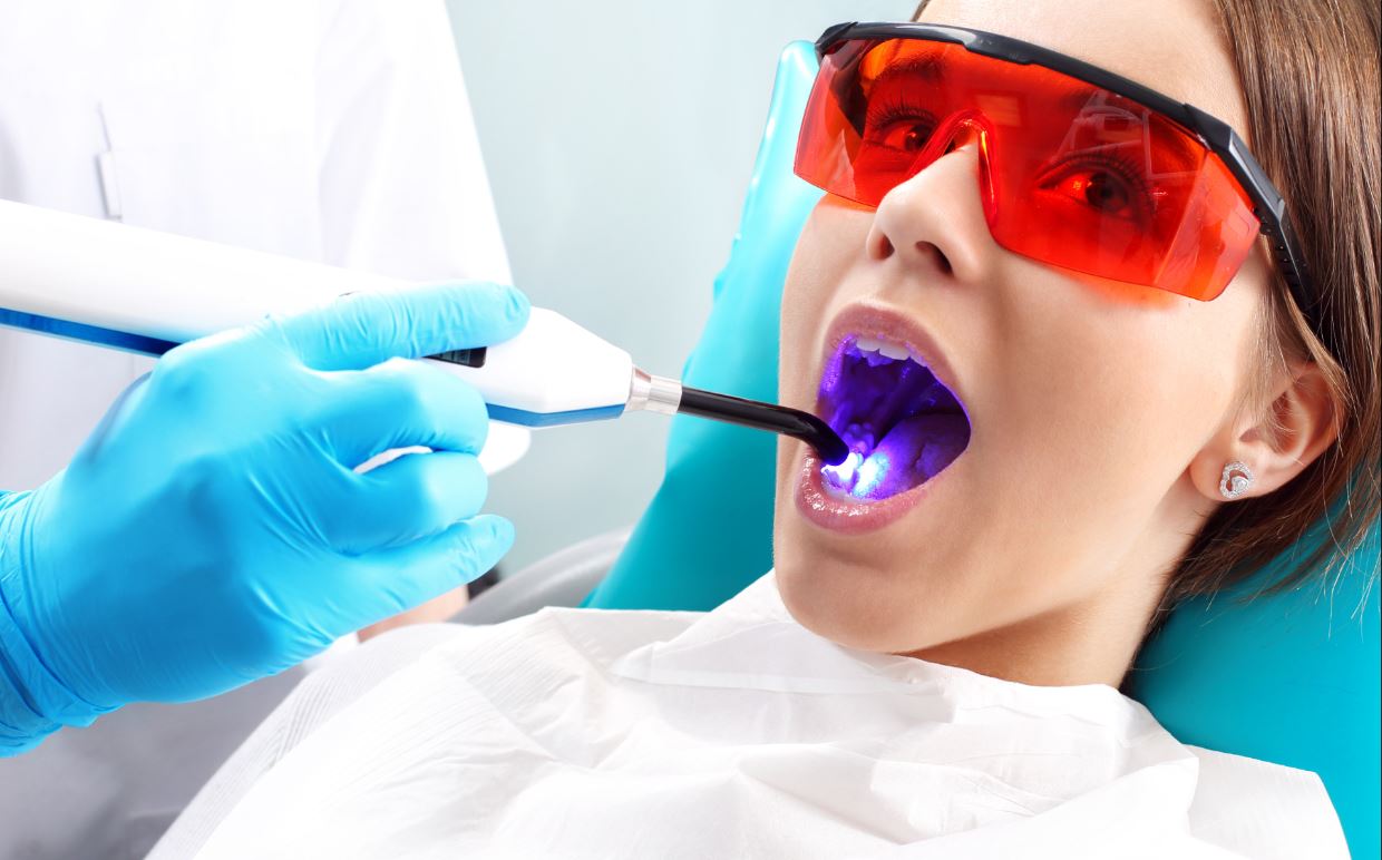 Fissure sealants to prevent tooth decay