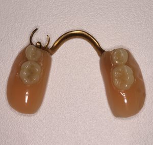 metal-denture-2