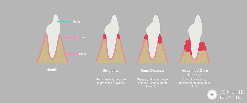 stages-of-gum-disease