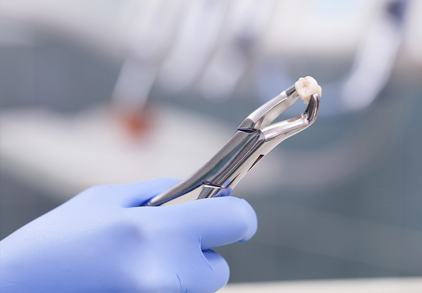 Tooth Extraction Online Dentist