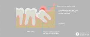 wisdom-tooth-stuck-under-gum