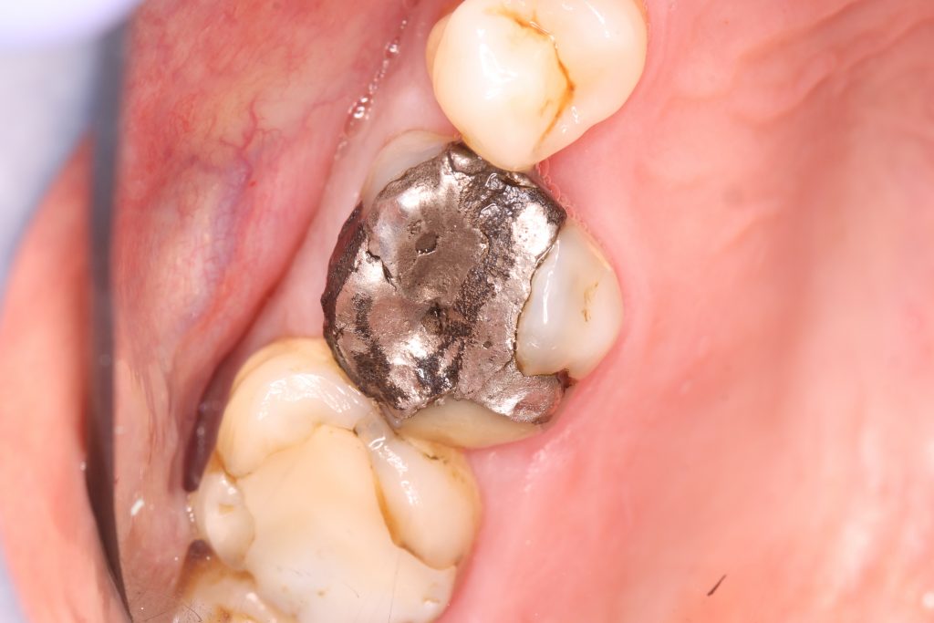 Large amalgam filling Online Dentist