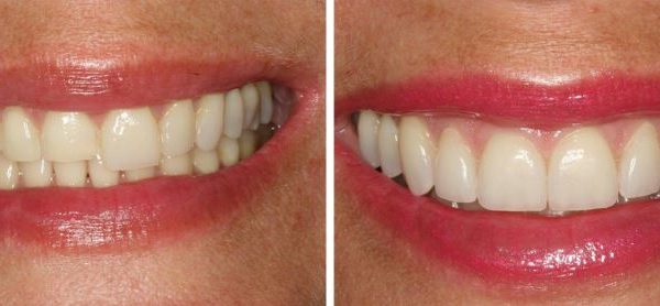 Before and after Veneers added