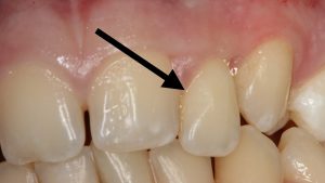 Aggressive Gum Disease close up