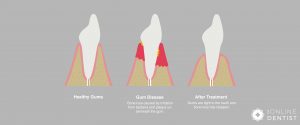 Gum Disease Treatment Diagram