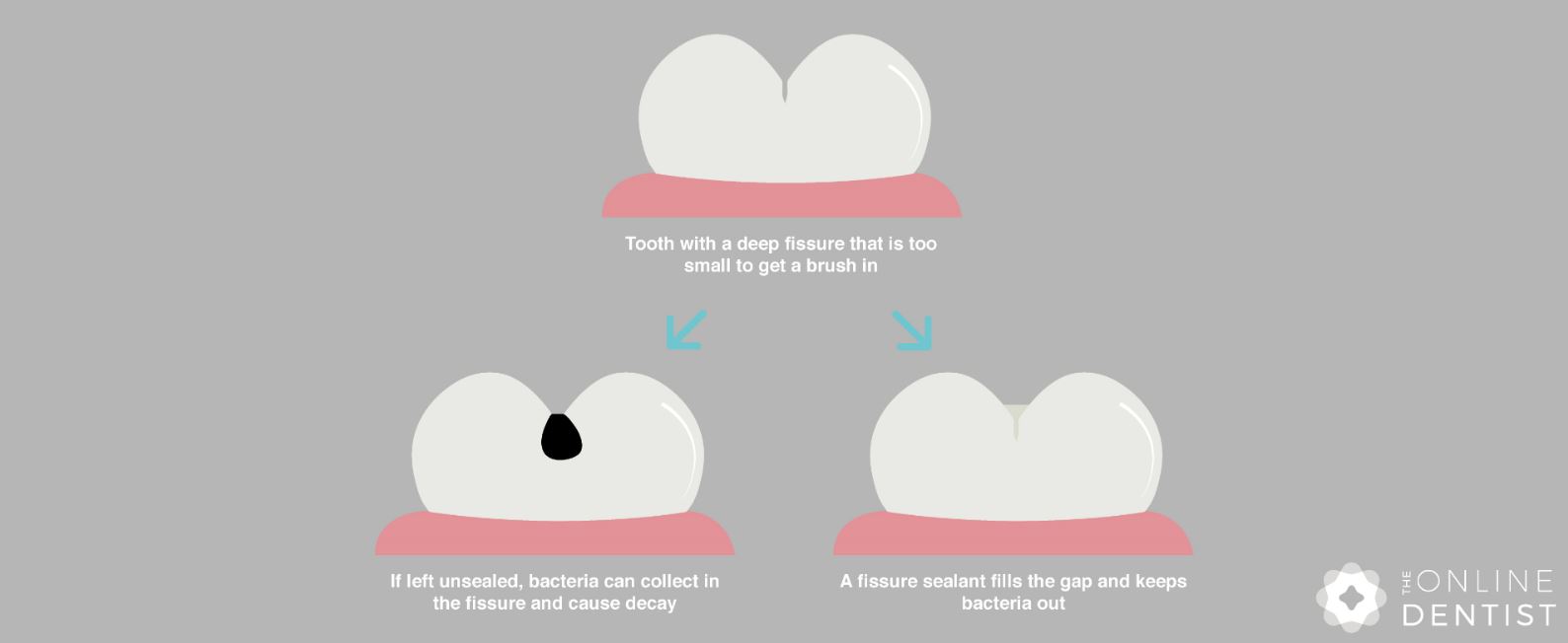 Fissure Sealants Diagram - The Online Dentist