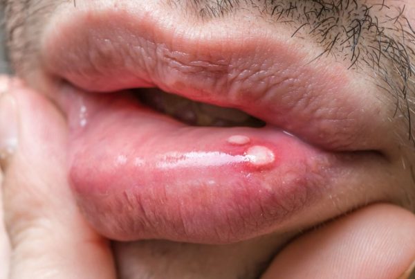 Mouth ulcer - The Online Dentist