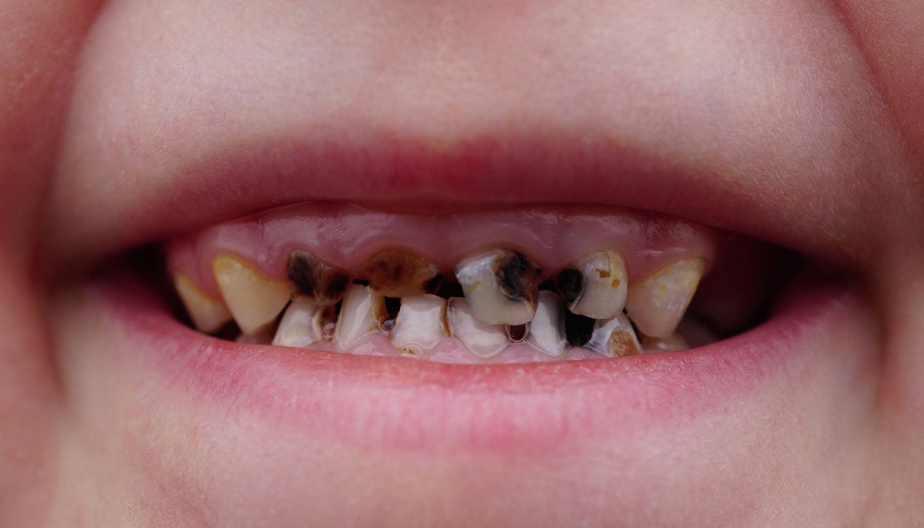 Tooth Decay FAQs