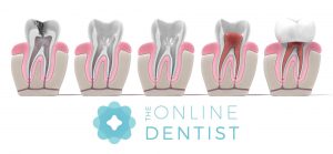 What does your dentist do for a root canal filling?