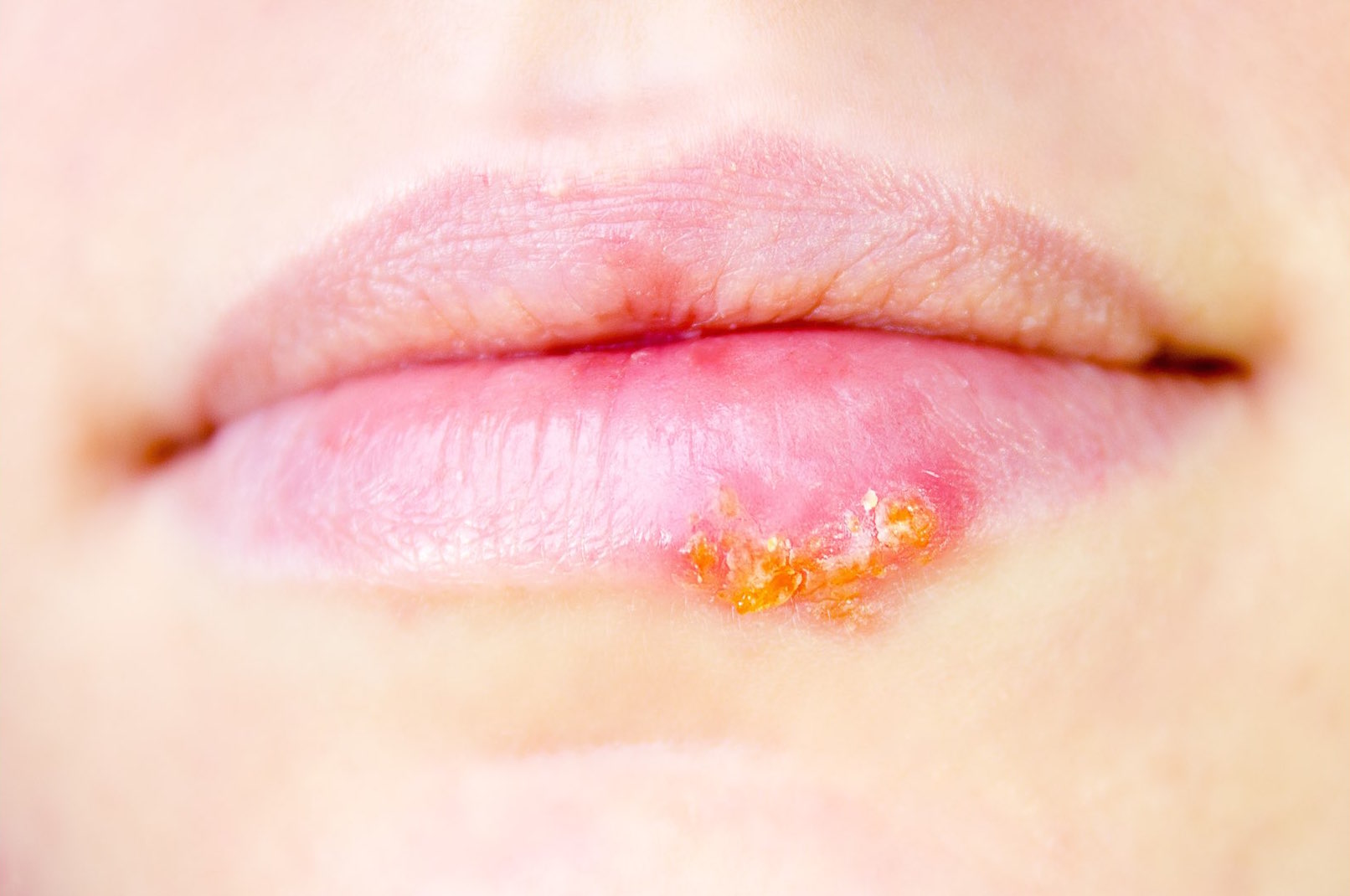 Cold sore The Online Dentist