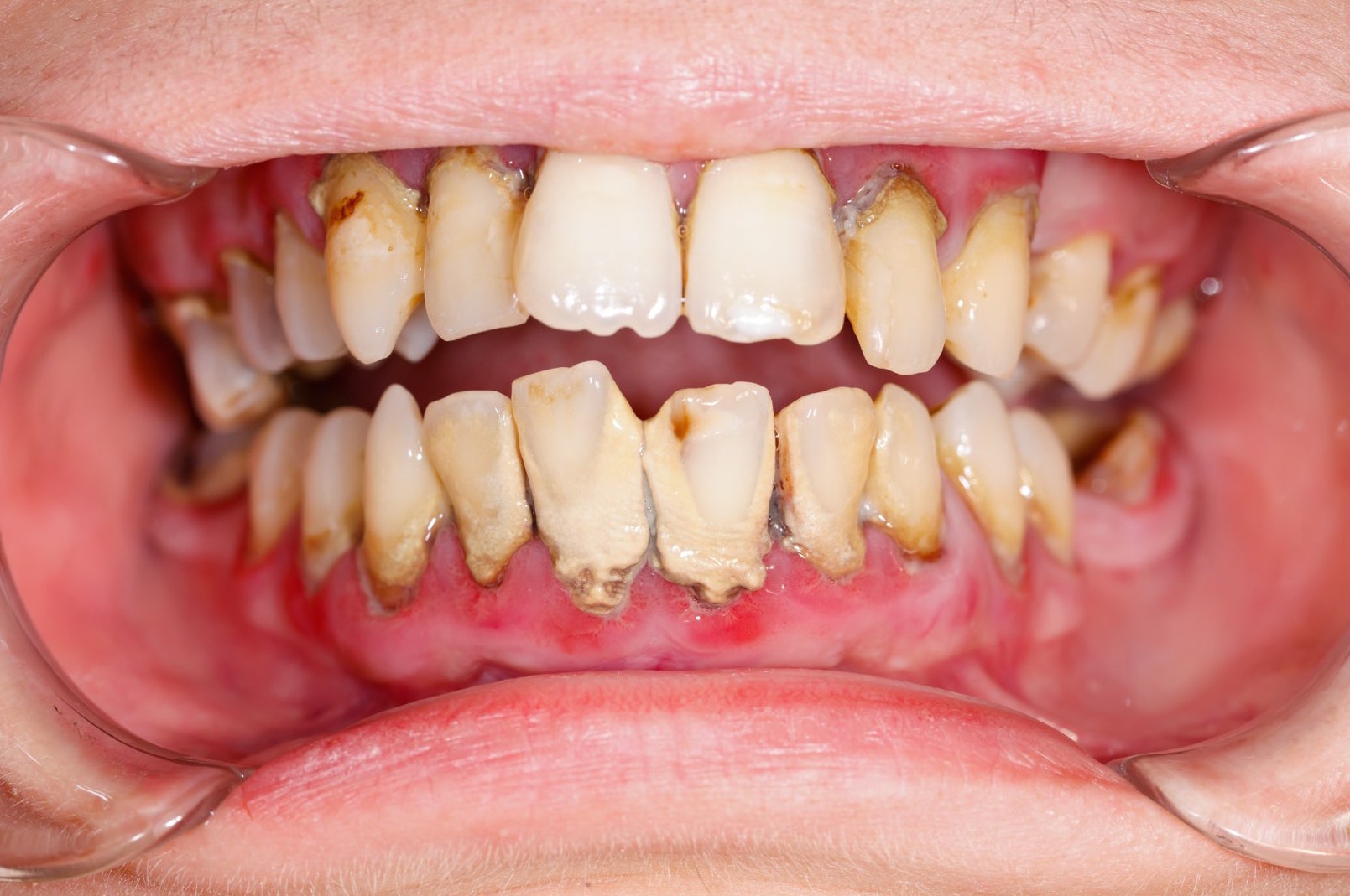 Gum disease FAQs
