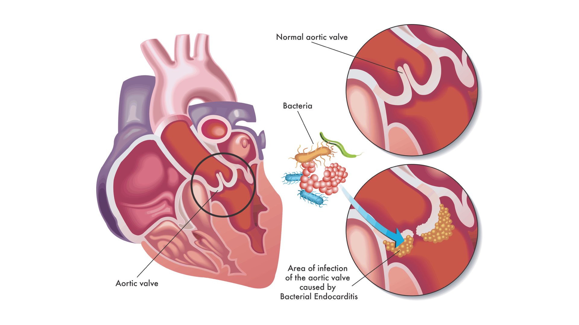 Bacterial infection on heart valve